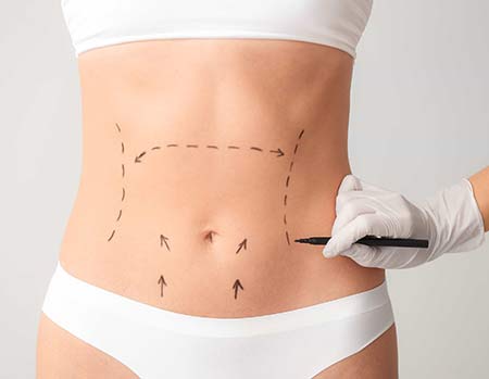 abdominoplasty in Nagpur