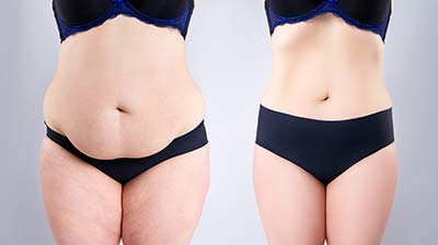 tummy tuck in Nagpur