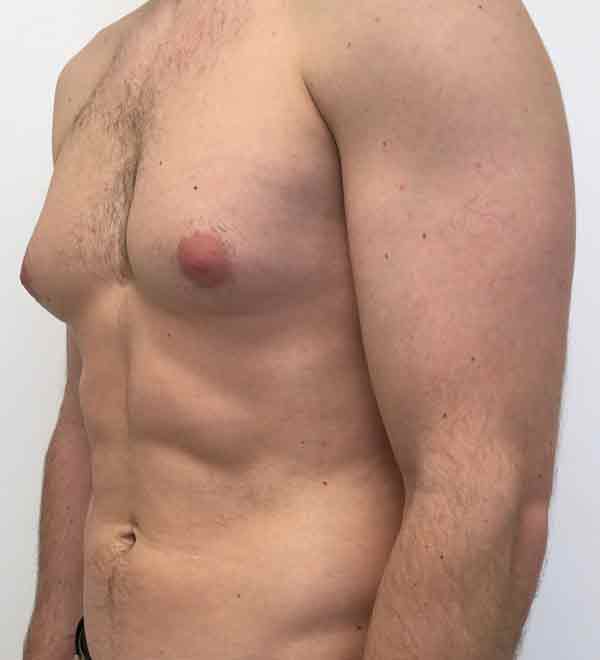 Gynecomastia surgery in Kanpur