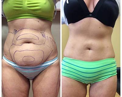 best liposuction in Nagpur