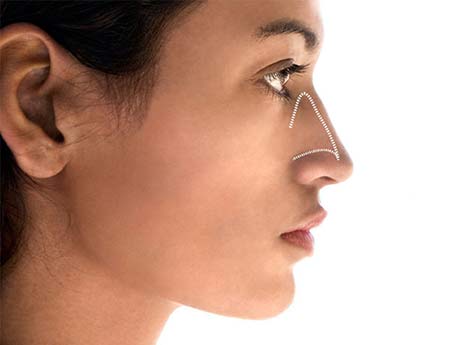 rhinoplasty in Nagpur