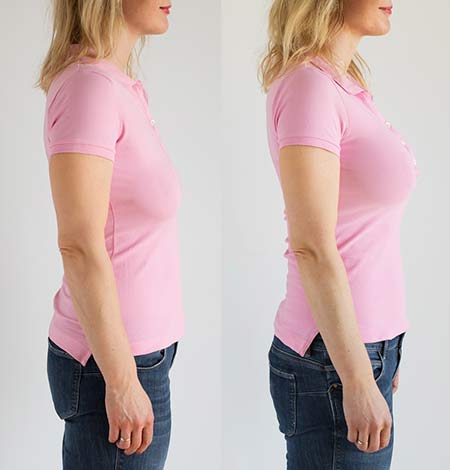 breast lift in Nagpur
