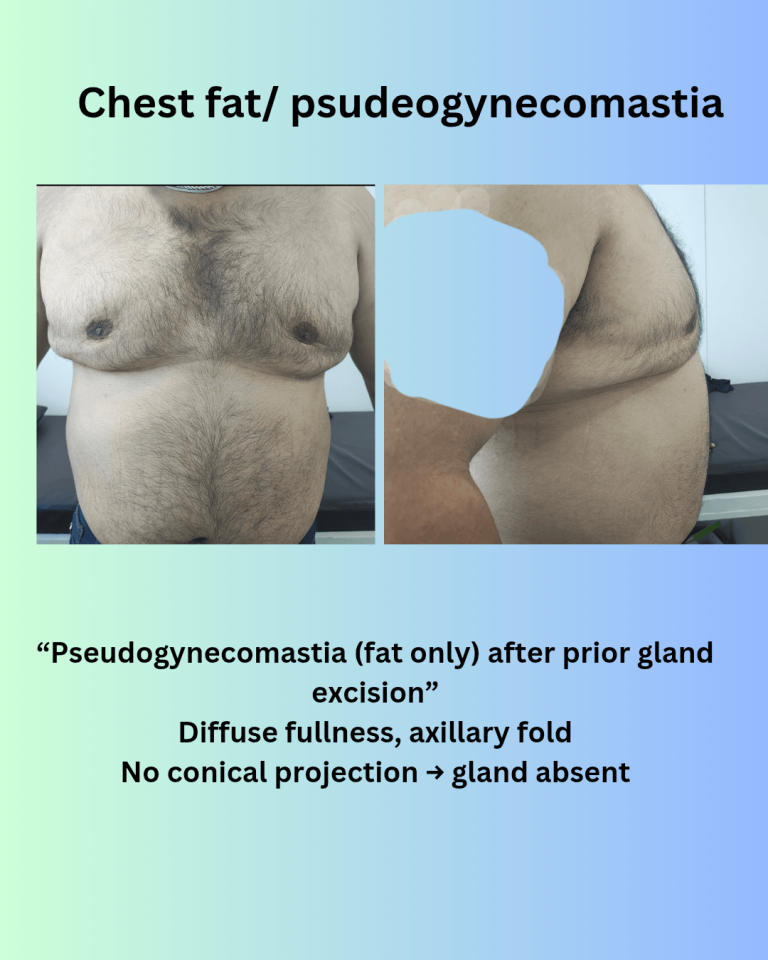 Chest Fat vs Gynecomastia: How to Tell the Difference | Dr Bhupendra Nagpur