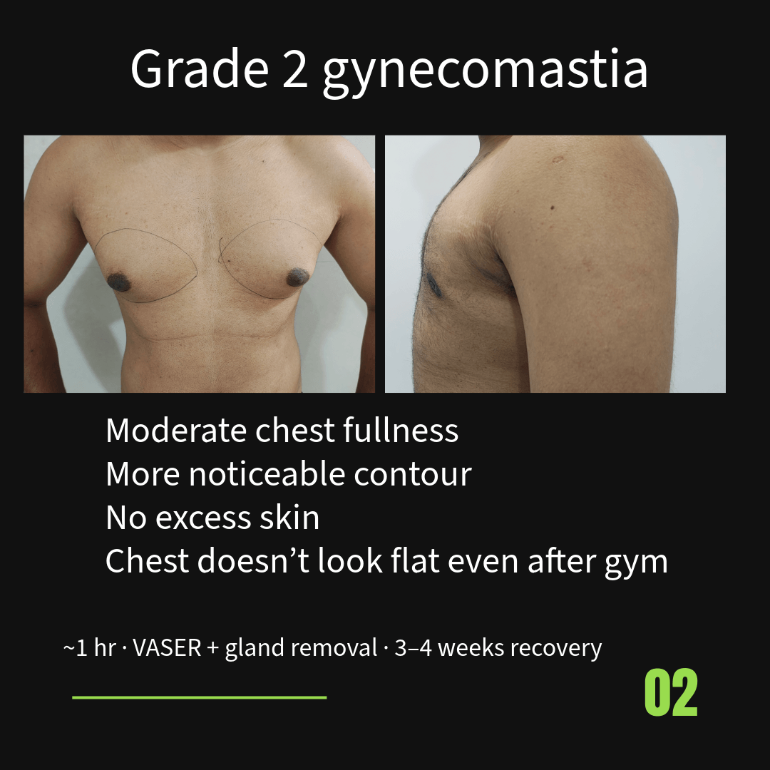 Grade 2 gynecomastia before surgery showing moderate chest fullness without excess skin and after correction using VASER liposuction and gland removal in Nagpur