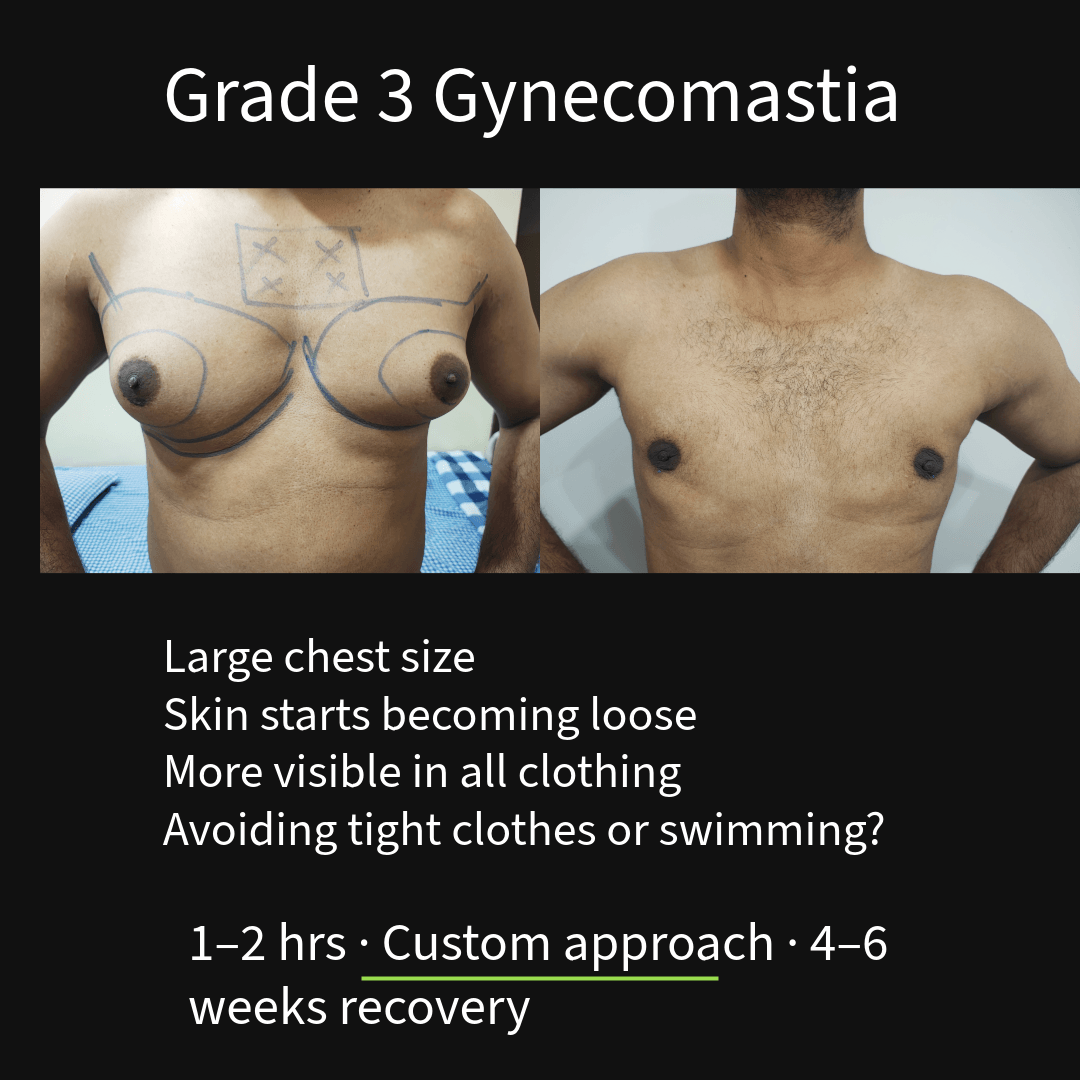 Grade 3 gynecomastia with larger chest size and mild skin looseness before and after surgical correction in Nagpur