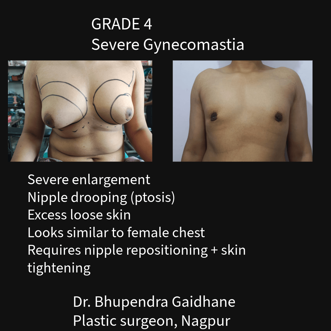Grade 4 severe gynecomastia with excess skin and nipple drooping before and after surgical correction with skin tightening in Nagpur