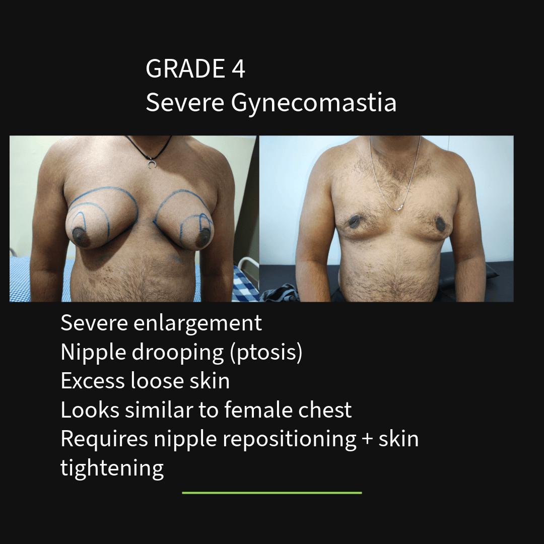Grade 4 severe gynecomastia with excess skin and nipple drooping before and after surgical correction with skin tightening in Nagpur