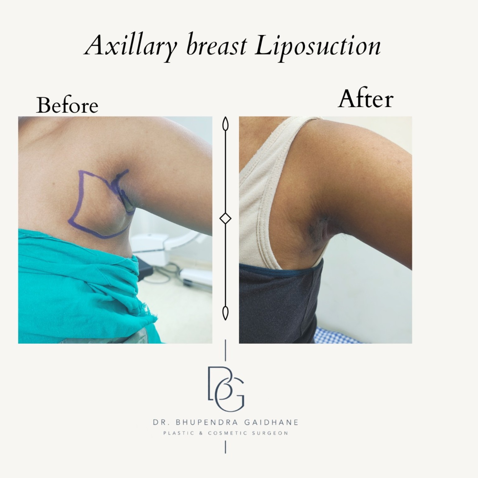 Localized axillary breast fullness before and after liposuction
