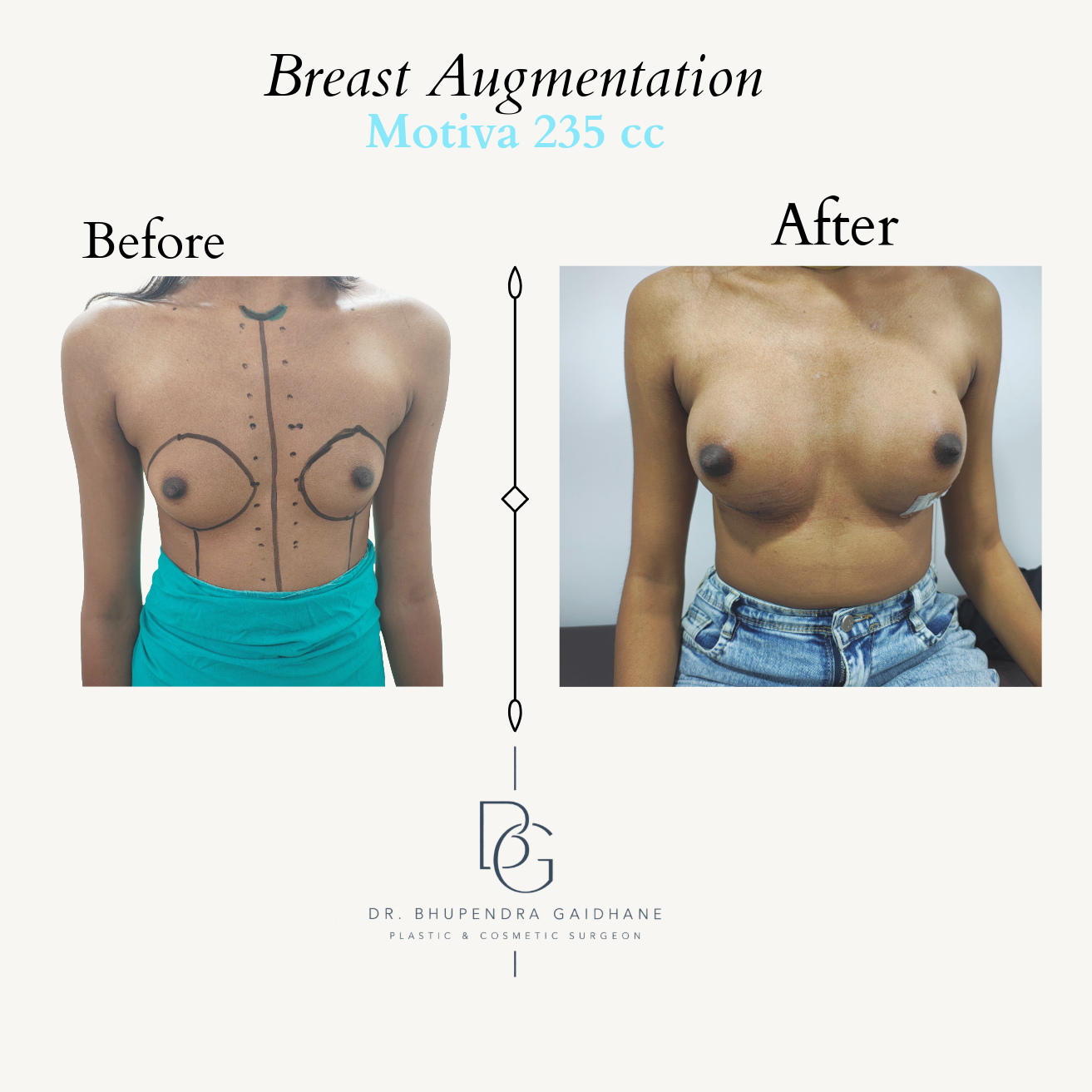 Breast augmentation before and after with Motiva 235 cc implant
