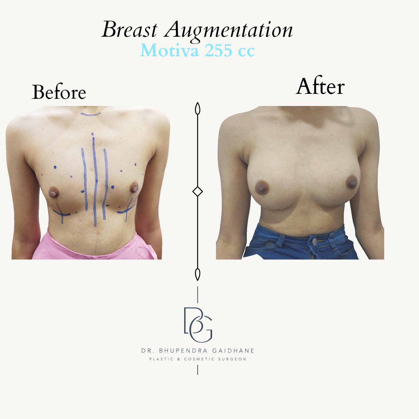 Breast augmentation before and after with Motiva 255 cc implant
