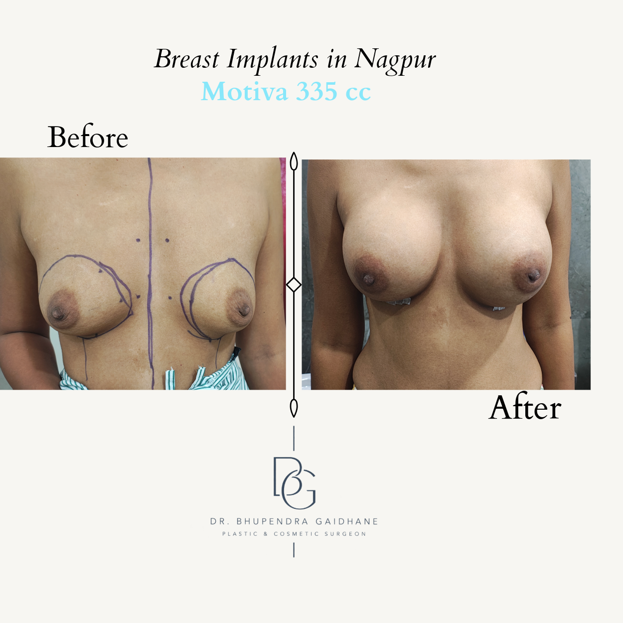 Breast augmentation before and after with Motiva 335 cc Full Profile implant
