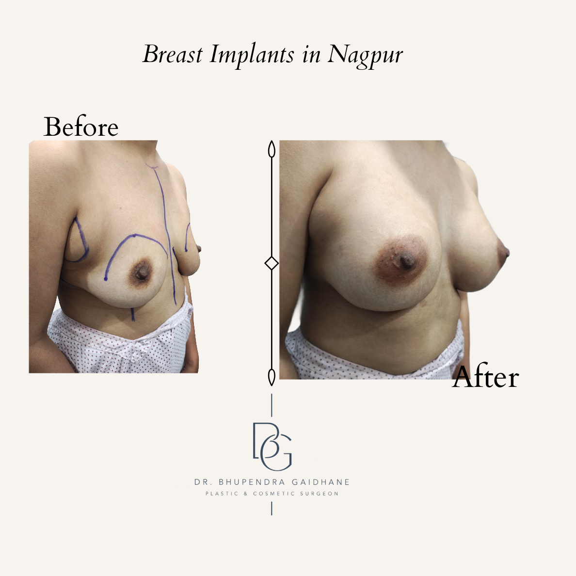 Breast augmentation before and after with Motiva 375 cc full profile implants in Nagpur