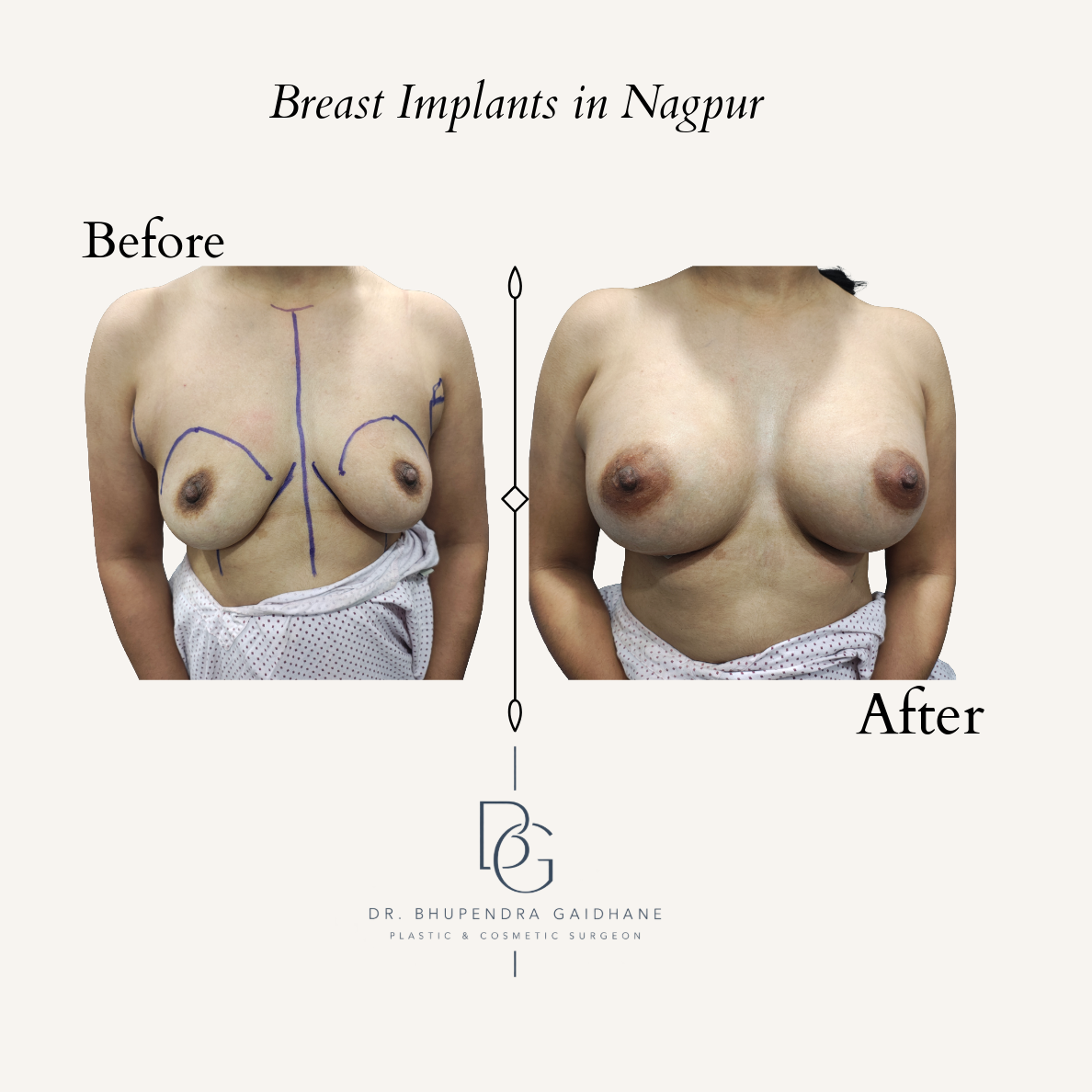 Breast augmentation before and after with Motiva 375 cc Full Profile implants in Nagpur