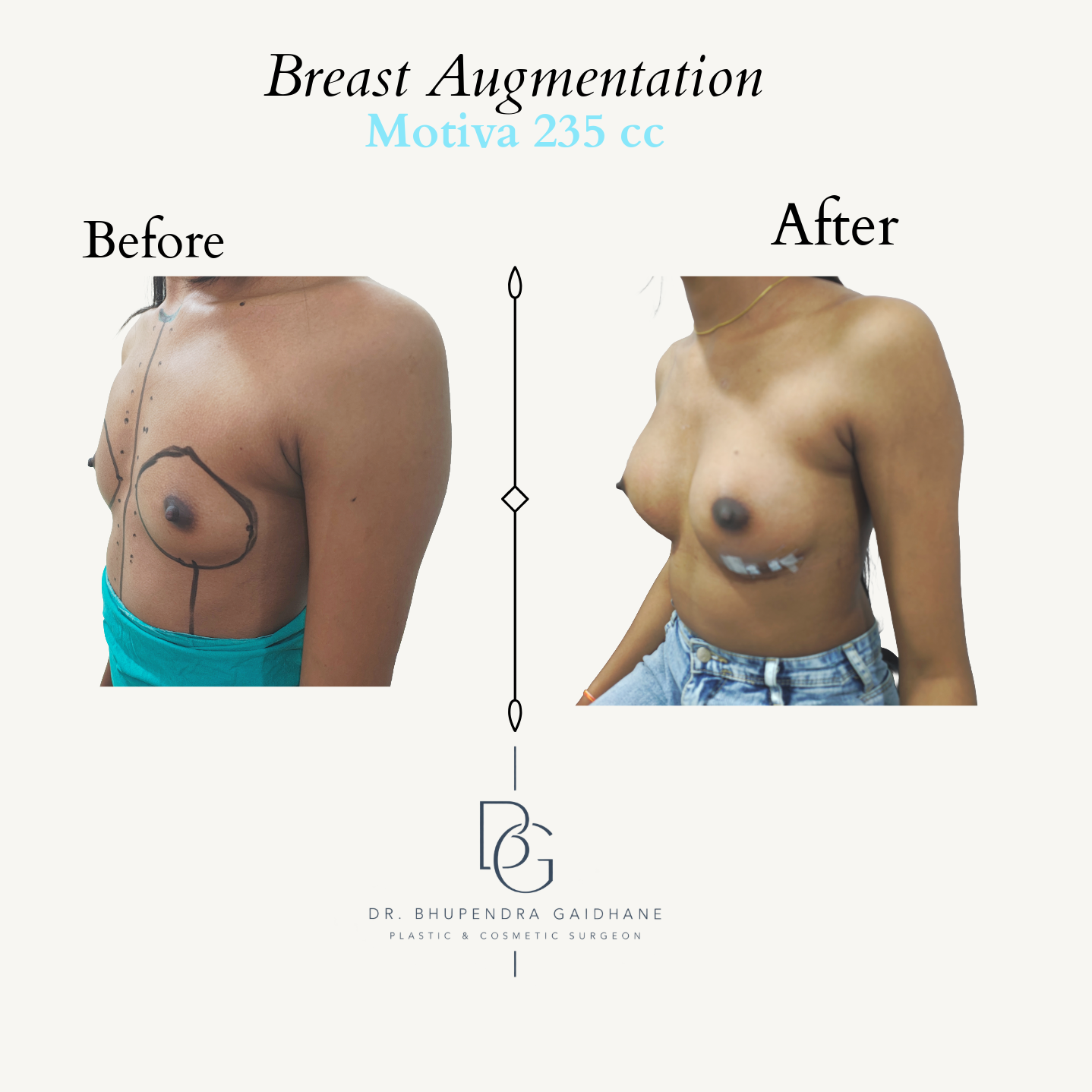 Oblique before and after view following breast augmentation with Motiva 235 cc implant