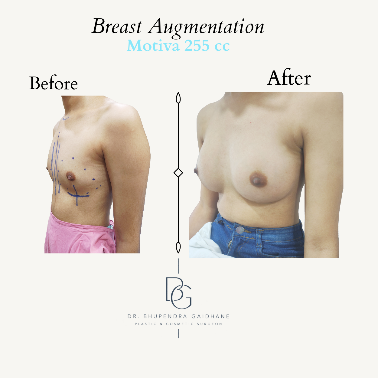 Oblique before and after view following breast augmentation with Motiva 255 cc implant
