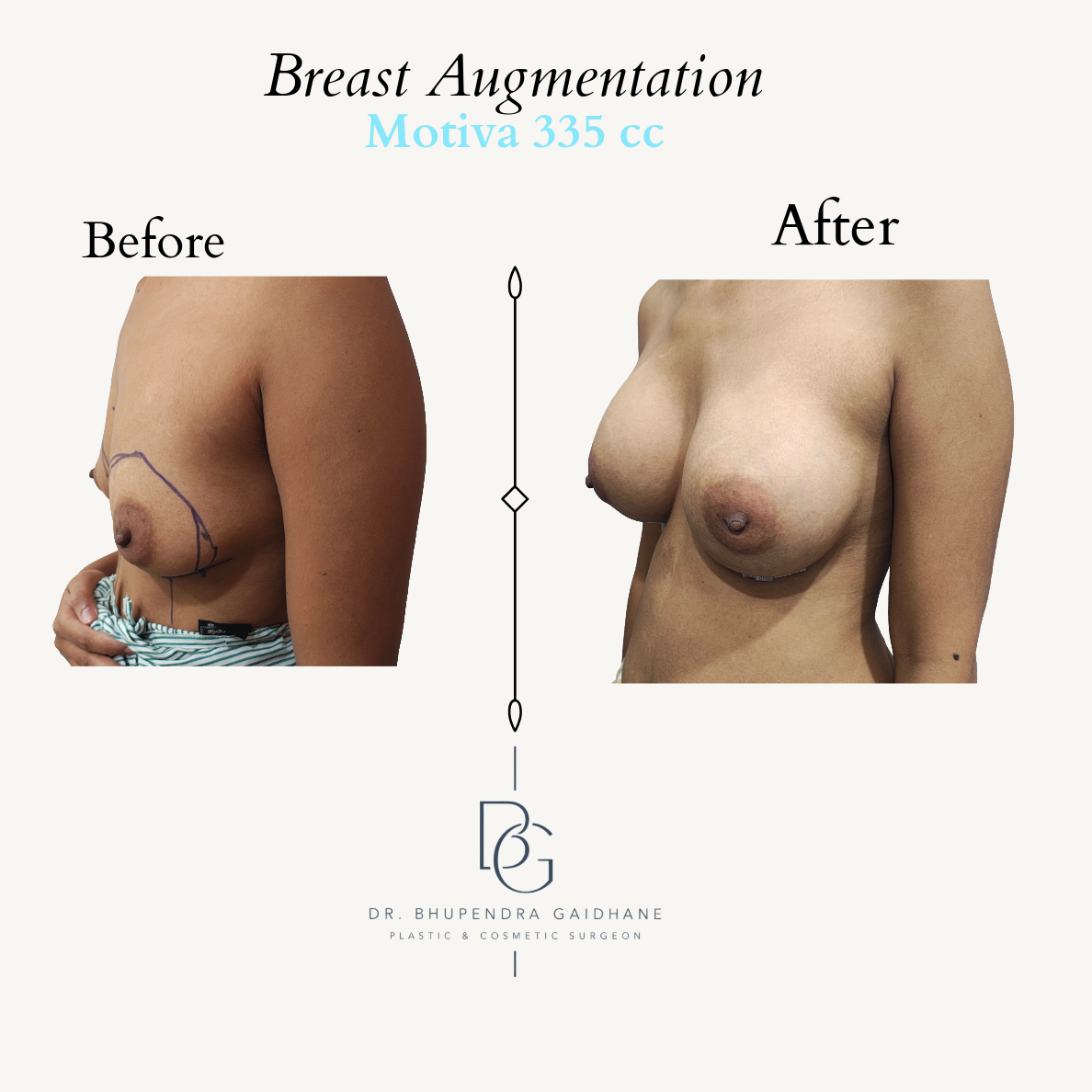 Oblique before and after view following breast augmentation with Motiva 335 cc implant