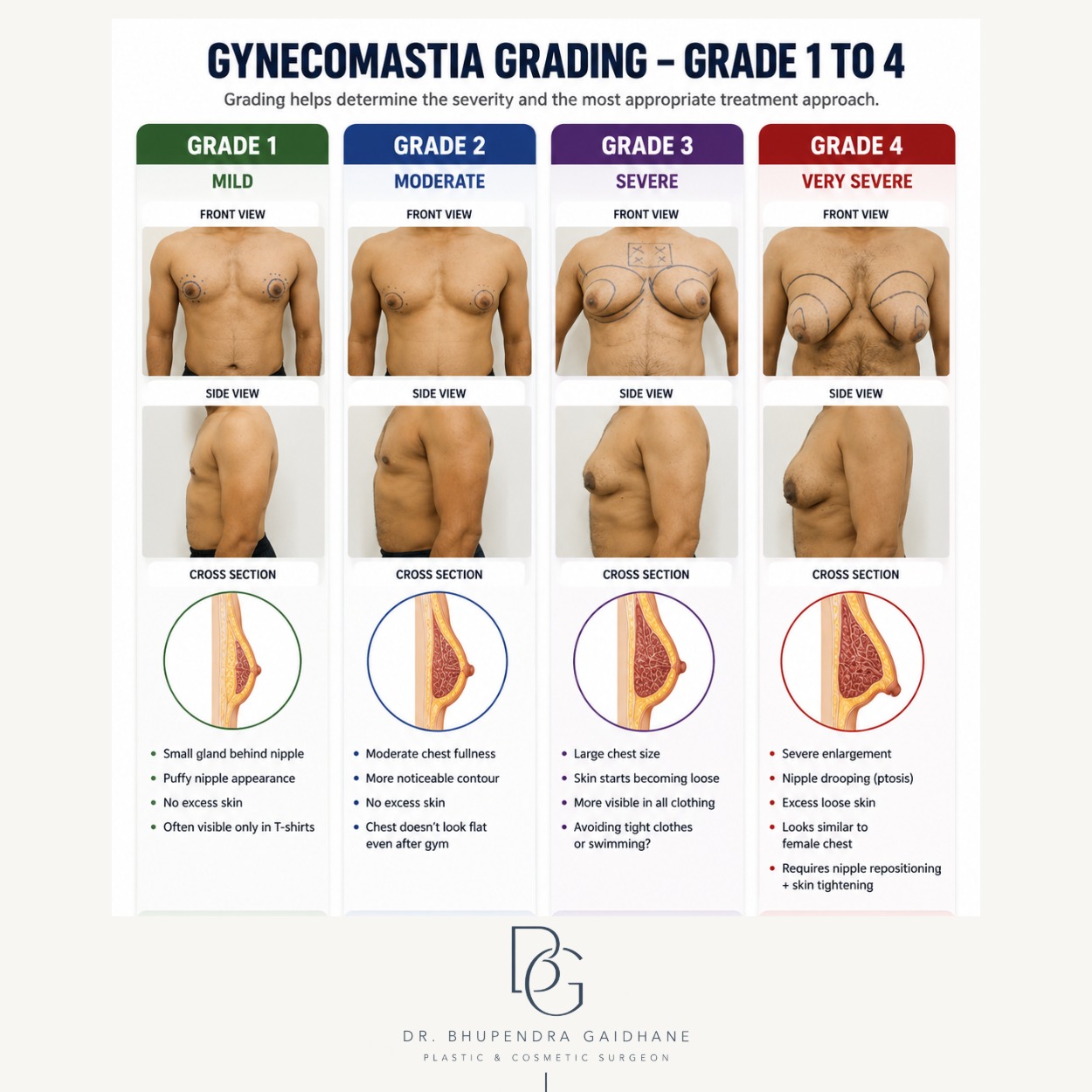 Gynecomastia grading from Grade 1 to Grade 4 showing front view, side view, and cross-sectional examples