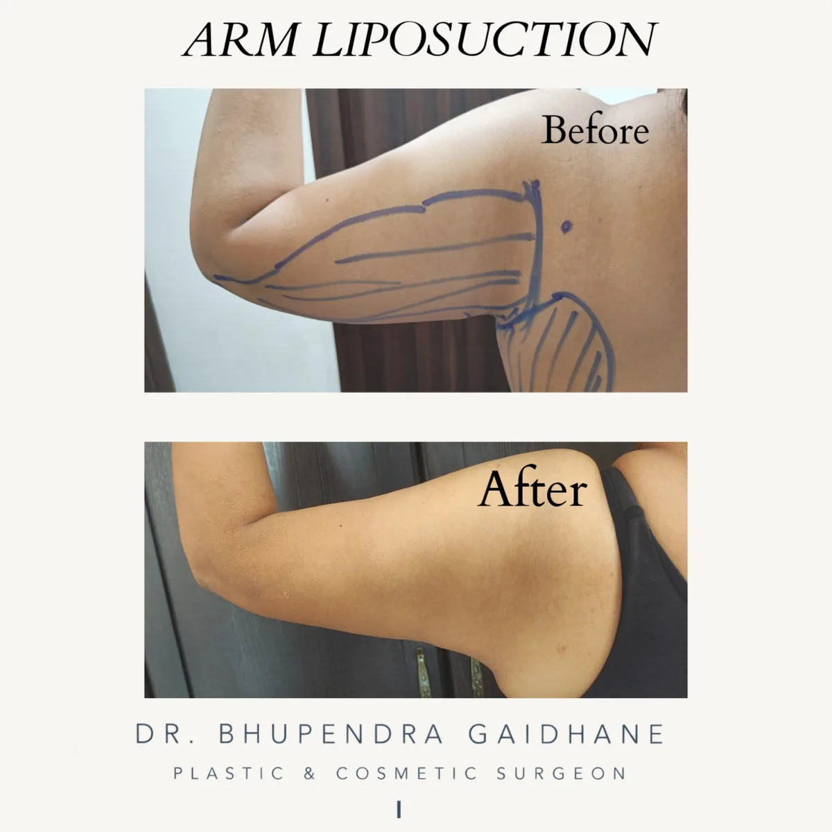 Arm liposuction before and after showing change in upper-arm contour