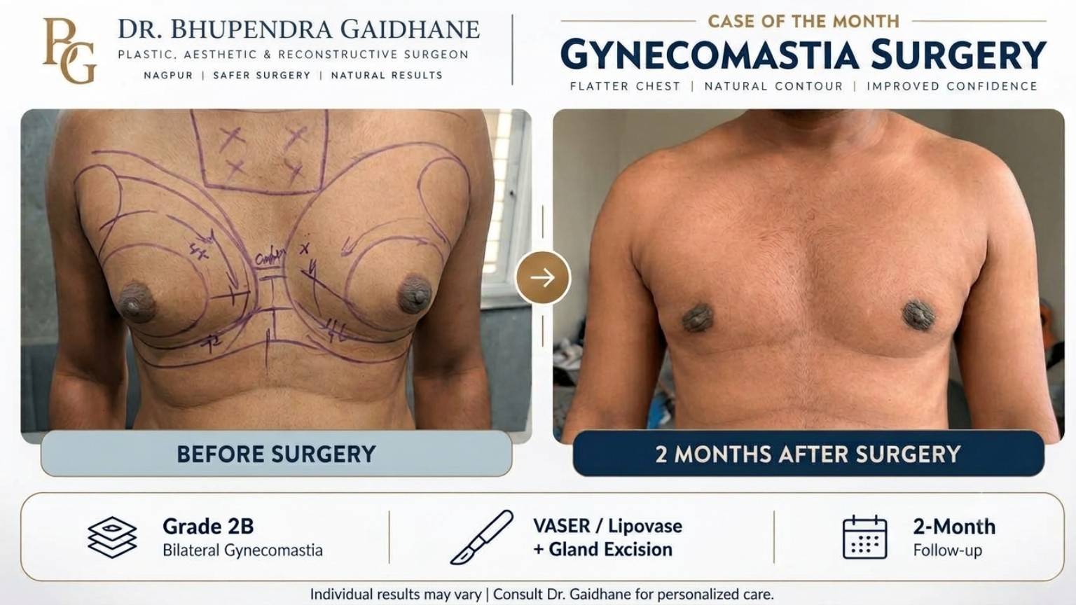 Gynecomastia surgery before and 2-month after result showing bilateral Grade 2B gynecomastia