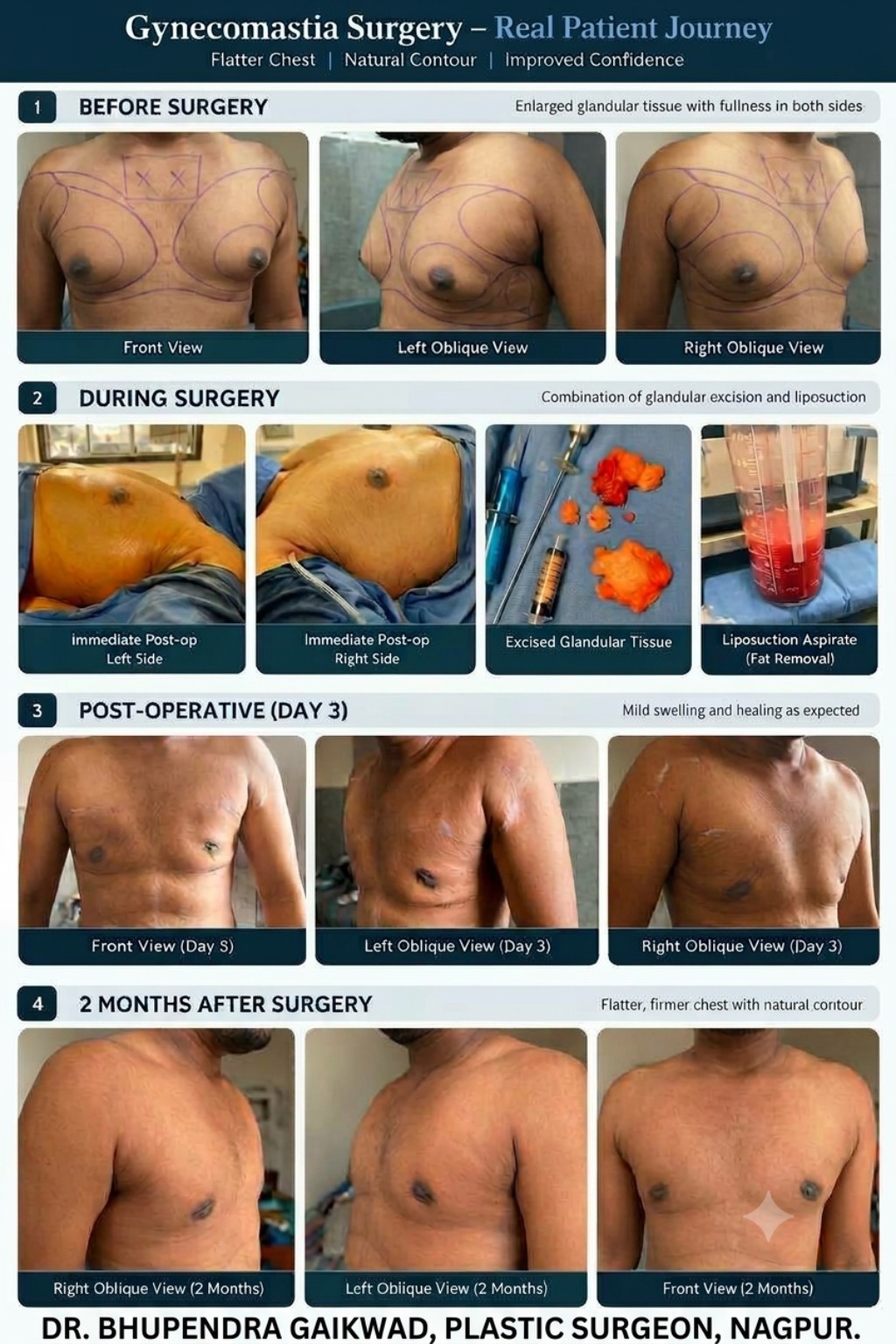 Gynecomastia surgery case of the month showing preoperative markings, operative photographs, Day 3 recovery and 2-month follow-up in a 23-year-old patient