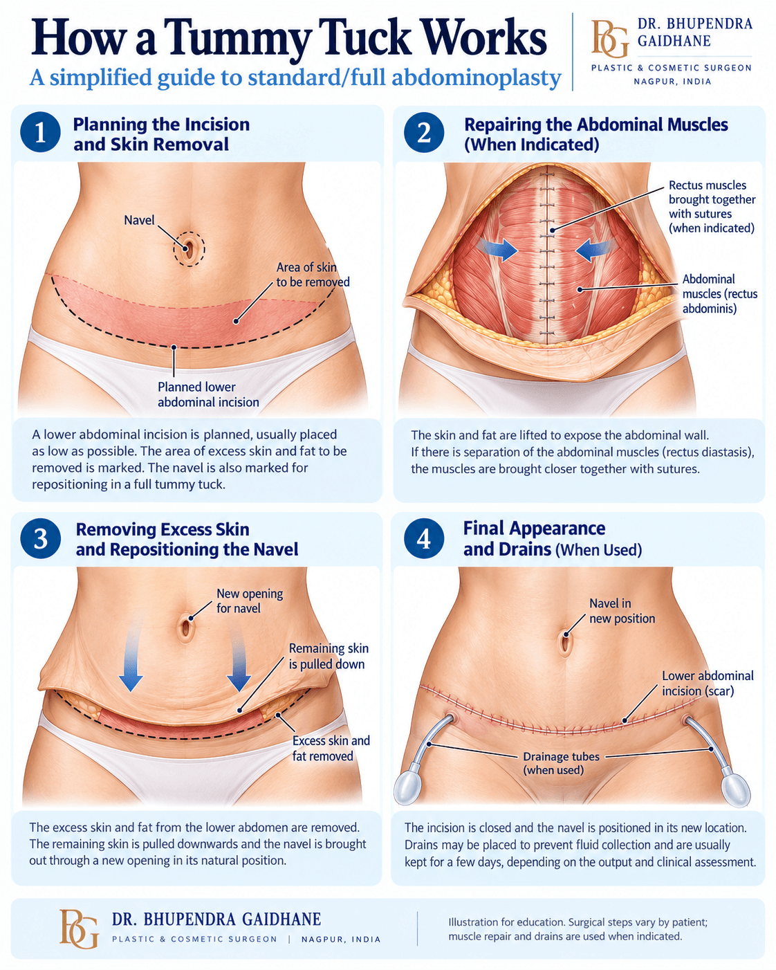 Medical infographic showing tummy tuck surgery steps including incision planning, abdominal muscle repair, excess skin removal, navel repositioning and drains when used