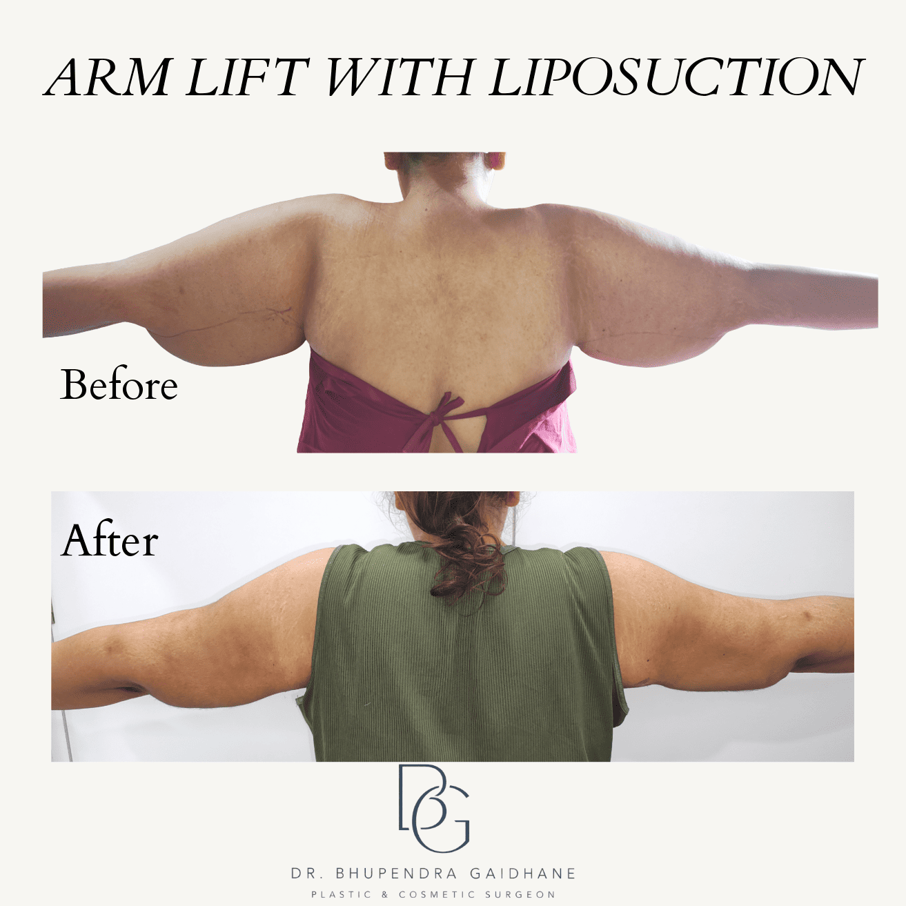 Before-and-after photographs illustrating upper-arm contour changes following arm lift surgery with liposuction