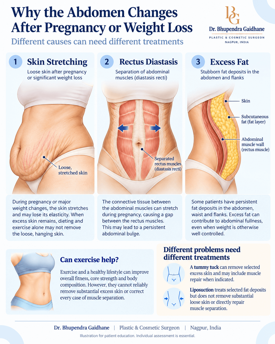 Medical infographic explaining loose abdominal skin, rectus diastasis and excess fat after pregnancy or weight loss